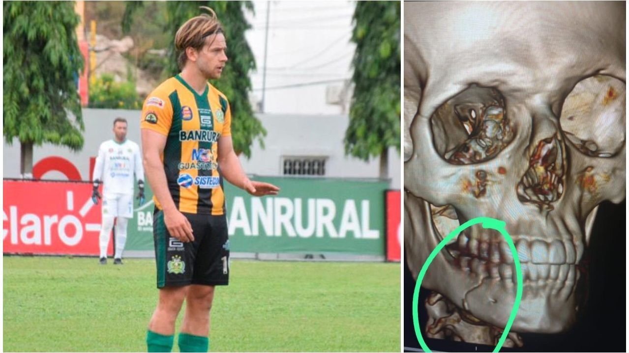 Diagnóstico de Andy Ruiz después de recibir un rodillazo en el rostro - ESPN