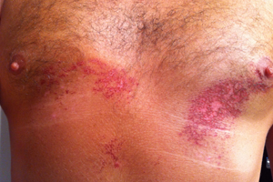 An extreme case of surf rash. Hint: when your nipples start bleeding, stop surfing.