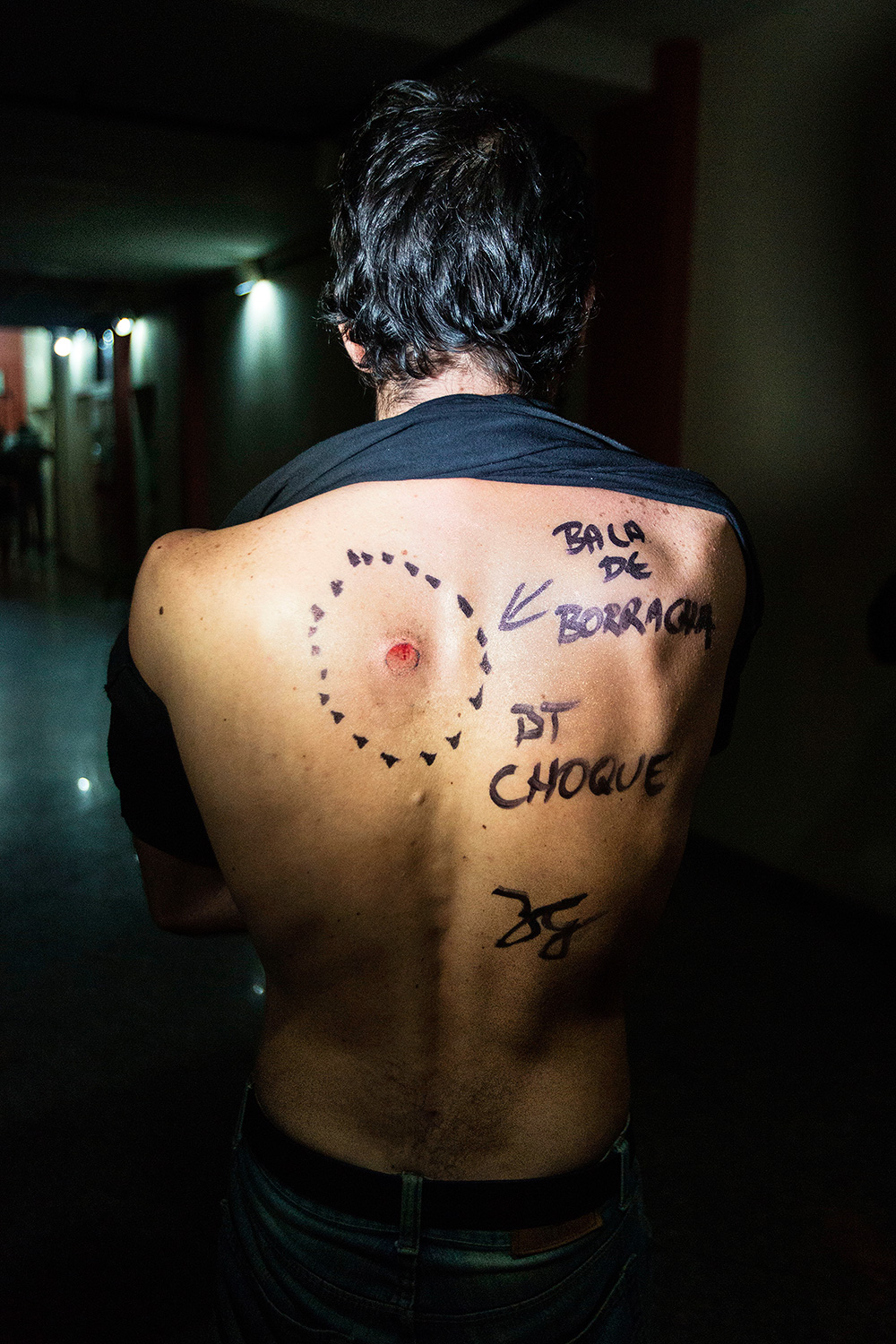 rubber bullet victim ESPN